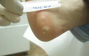 Siğil/Human Papilloma Virüsü (HPV) — Ayak Sigil