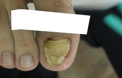 Tırnak mantarı tedavisi — Mantar Tedavisi