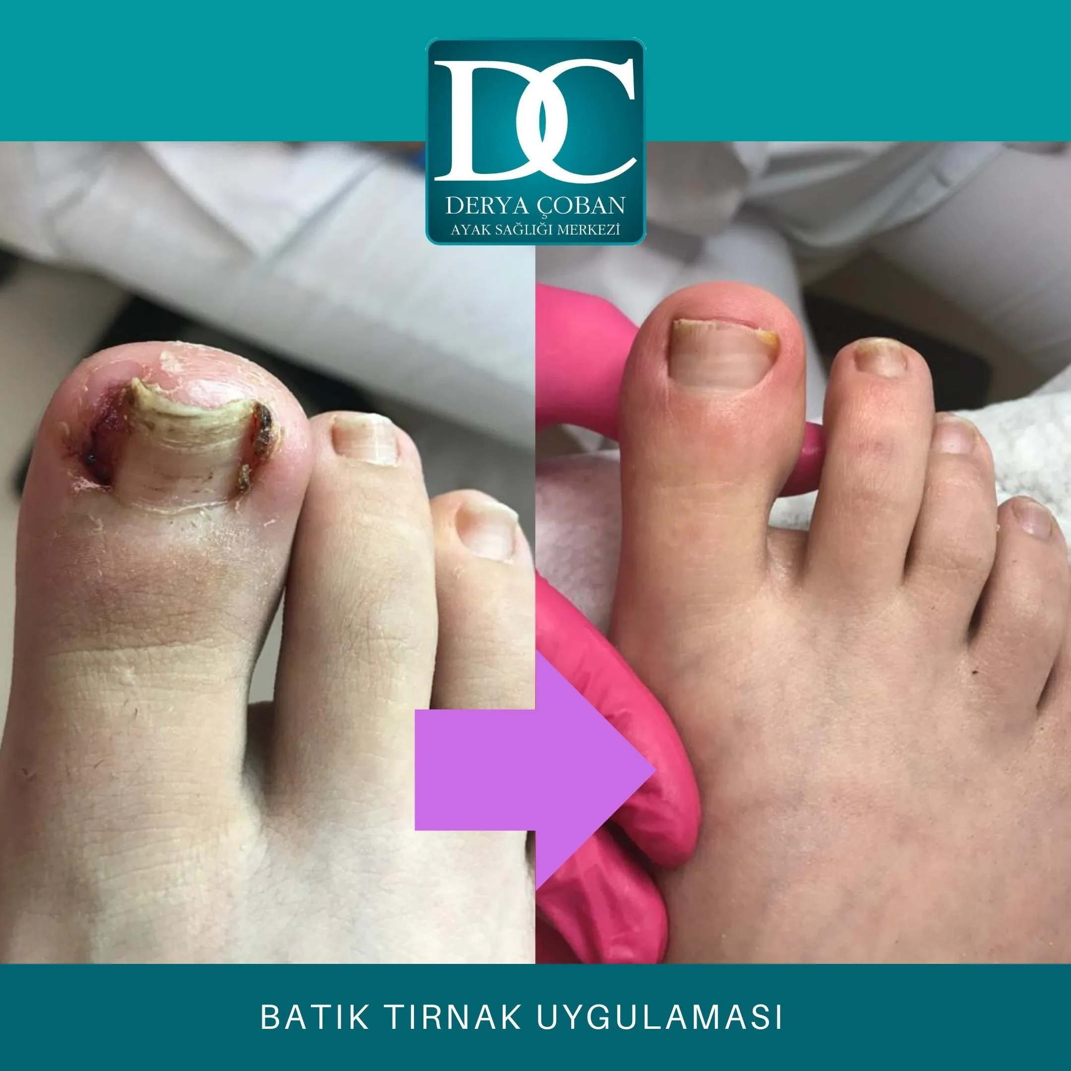 batık tırnak