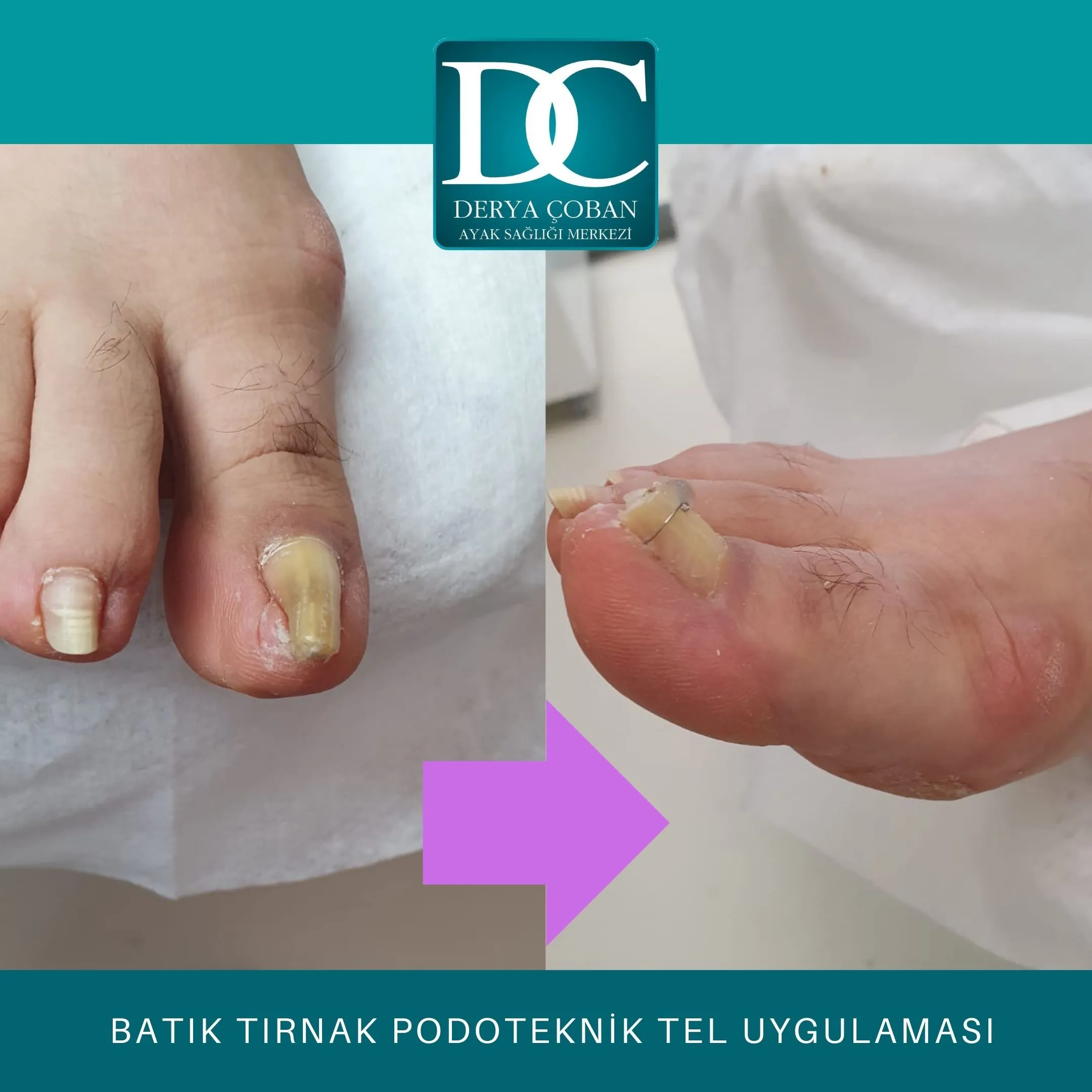 batık tırnak