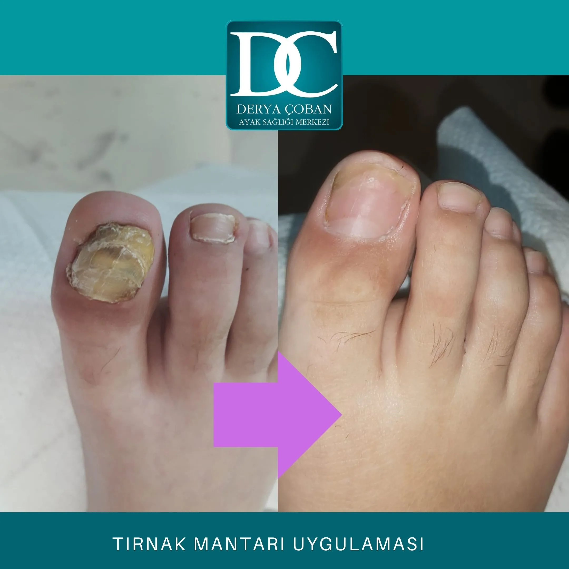 tırnak mantarı