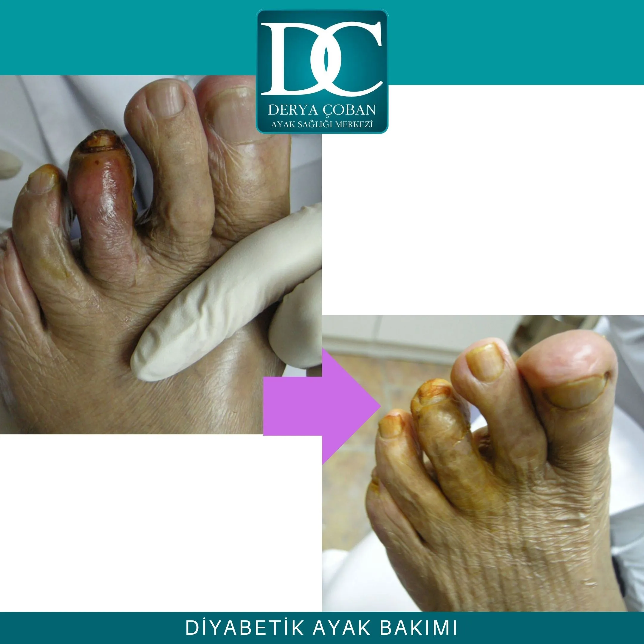 diyabetik ayak