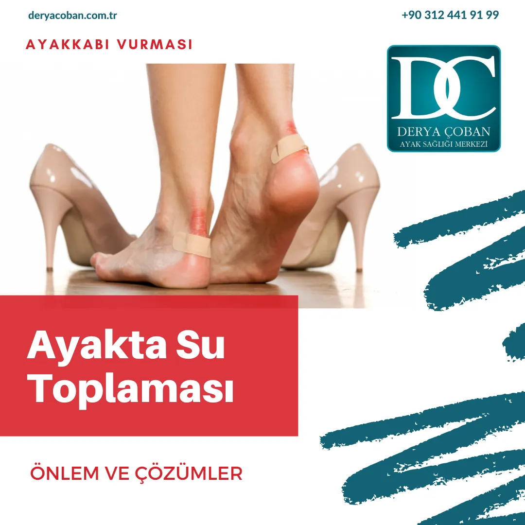Ayak Neden Su Toplar?