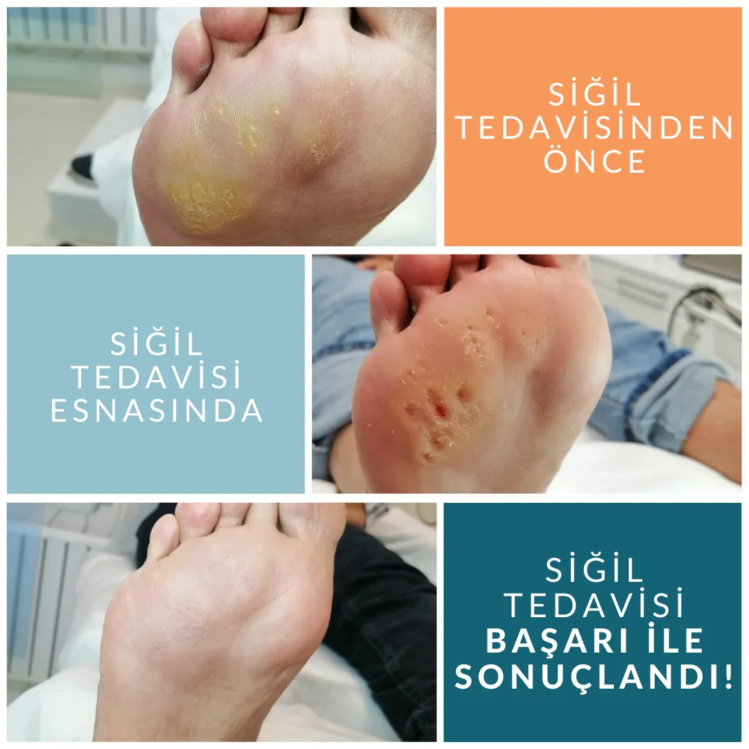 Siğil Tedavisi Nasıl Olur