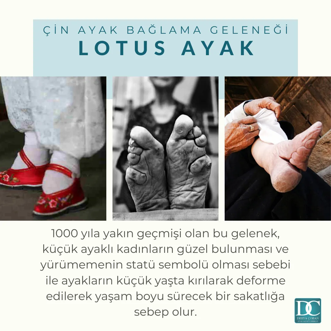 Ayak Bağlama Geleneği - Lotus Ayak nedir?