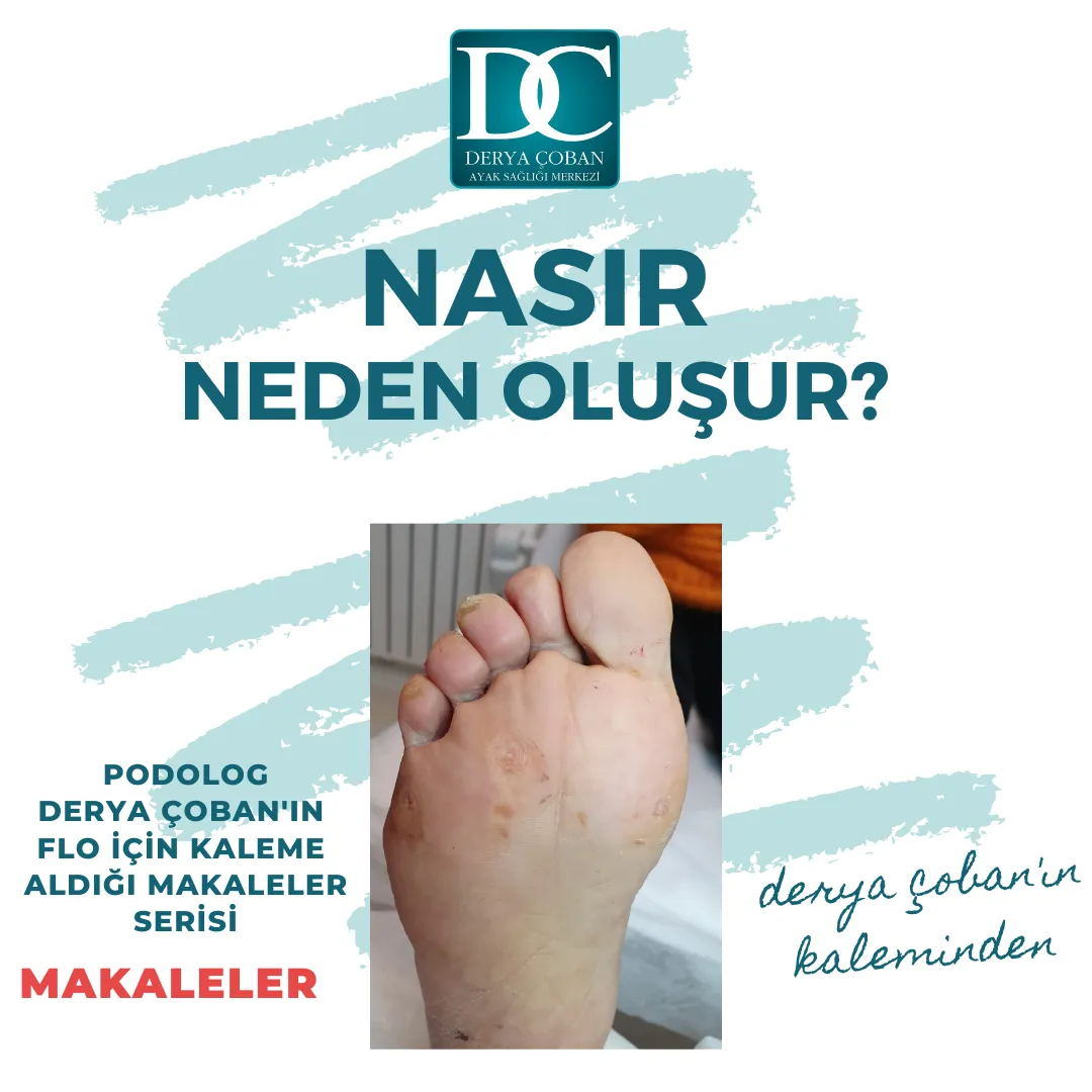 Nasır Neden Oluşur?