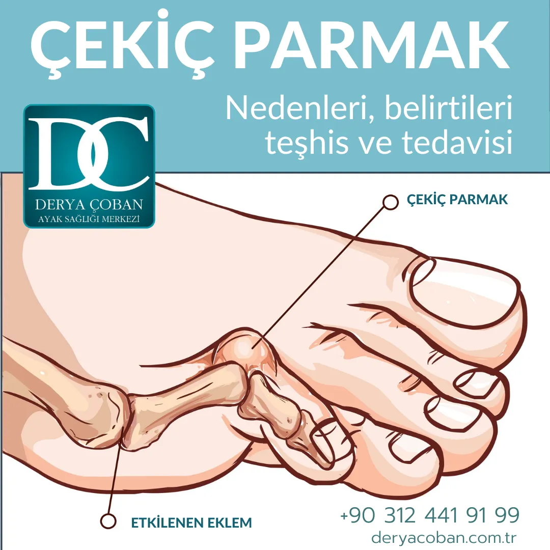Çekiç Parmak Nedir? Neden Oluşur?