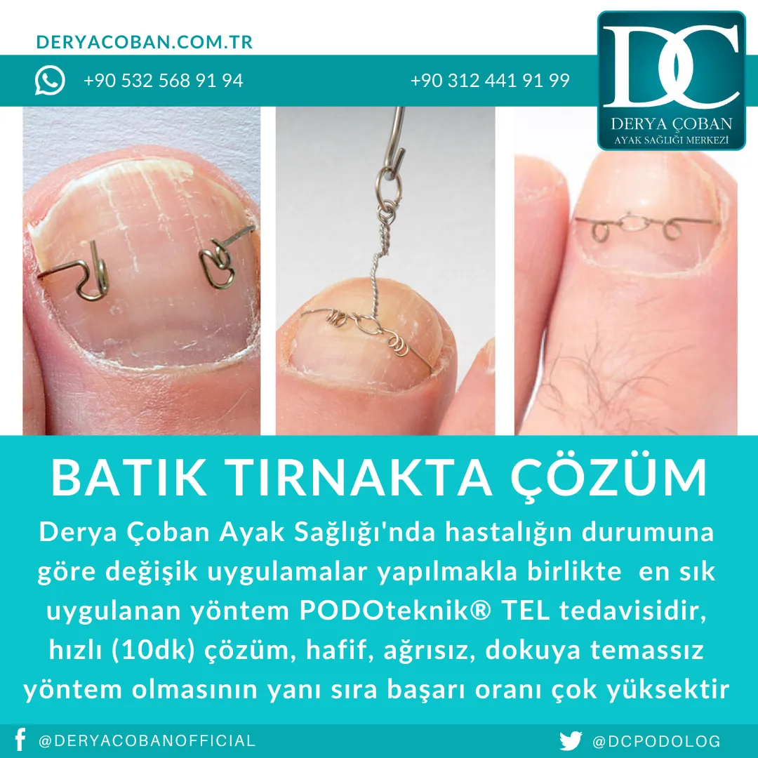 Batık Tırnak Nedir? Nasıl Çözülür?