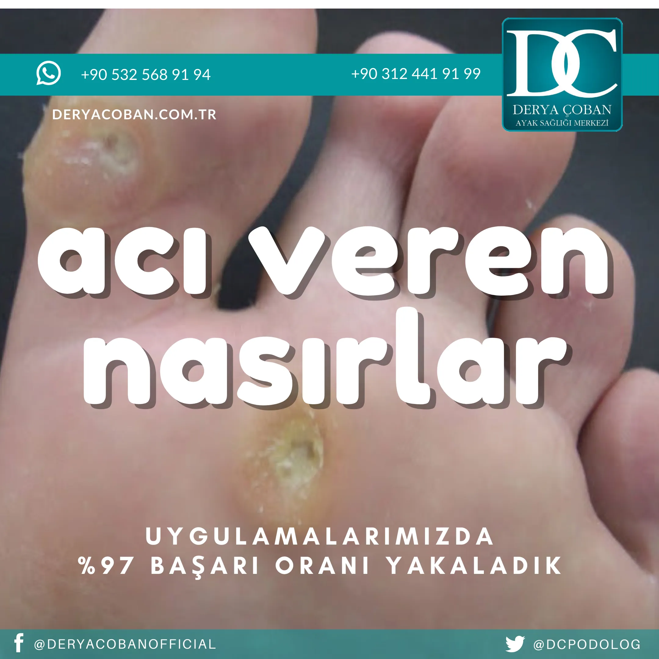 Nasır Ağrısı Nasıl Geçer?