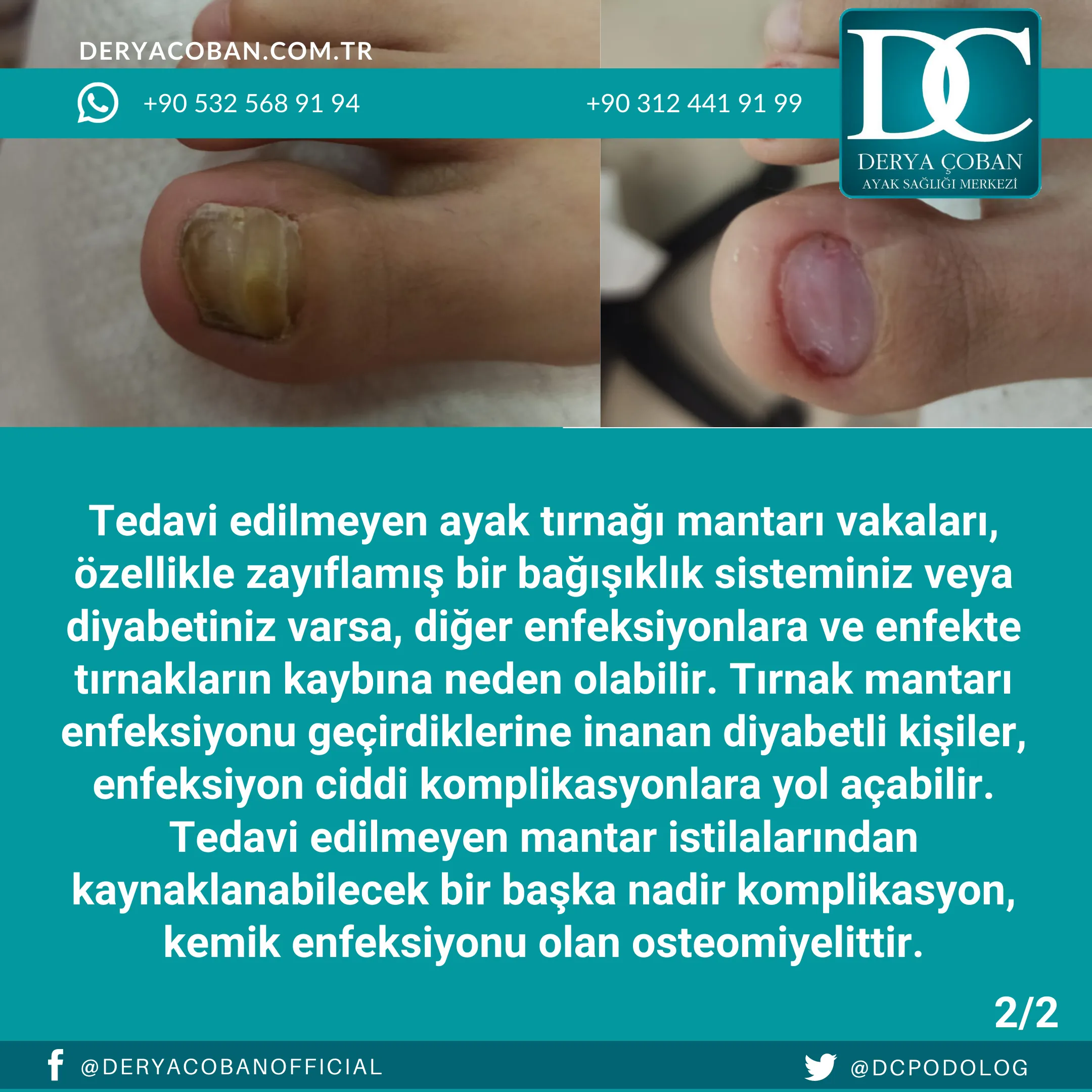 Tırnak Mantarı Nasıl Geçer?