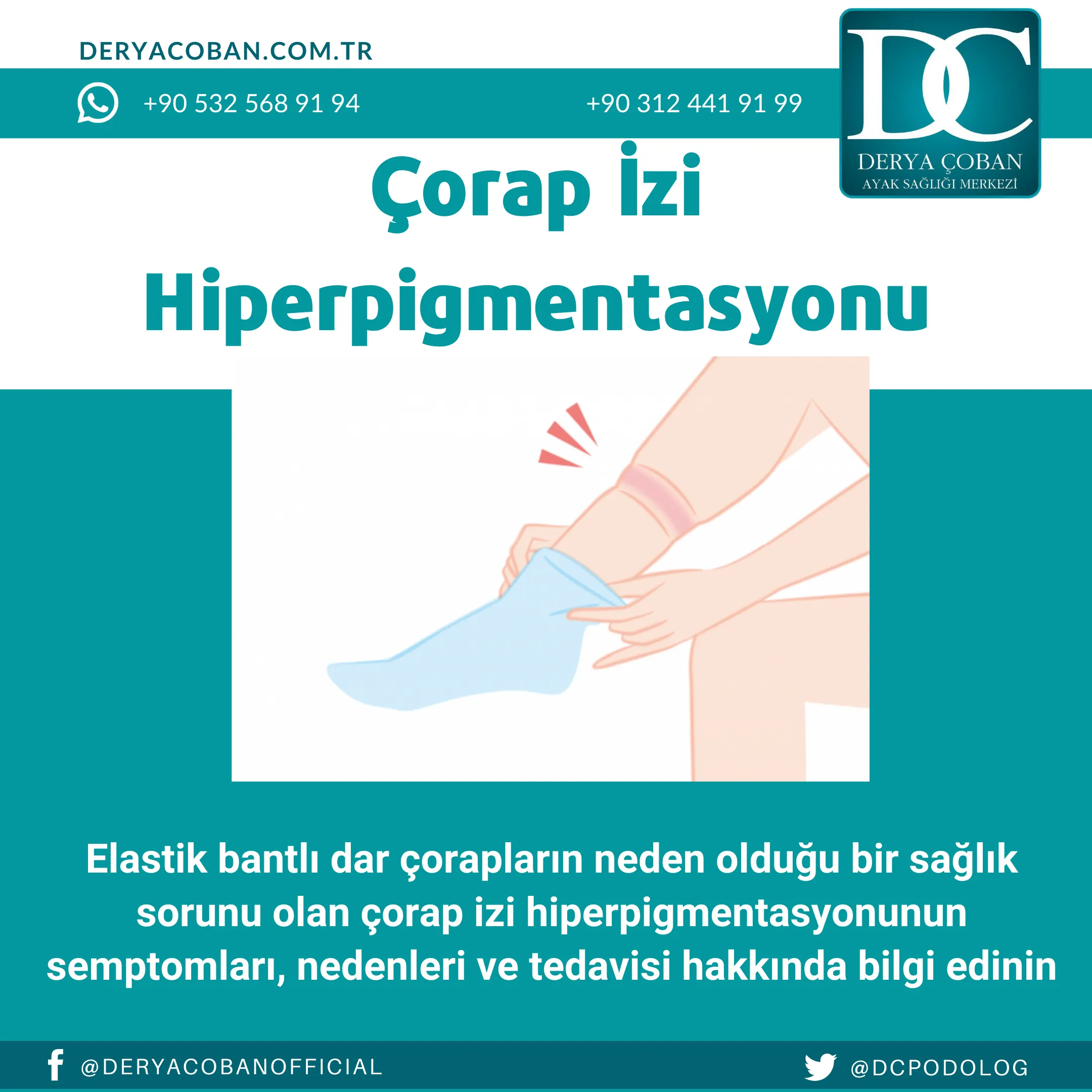 Çorap İzi Nasıl Geçer? Çorap İzi Hiperpigmentasyonu