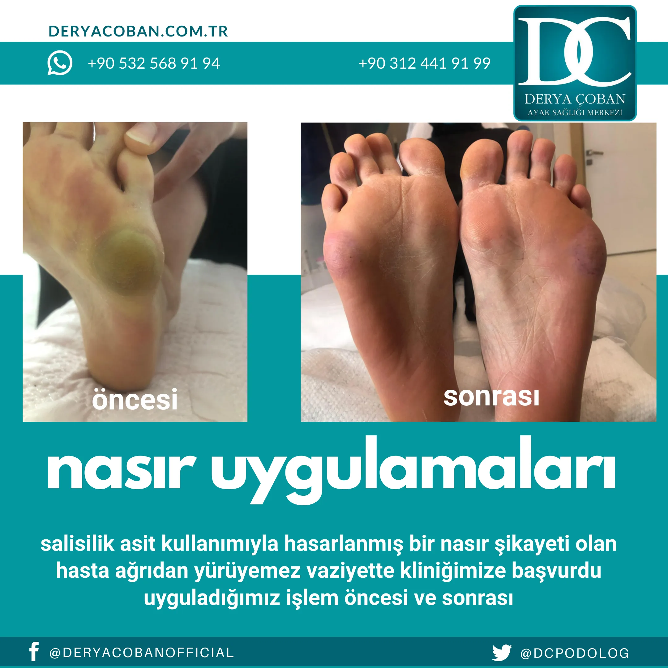 Nasır Nasıl Düzelir?