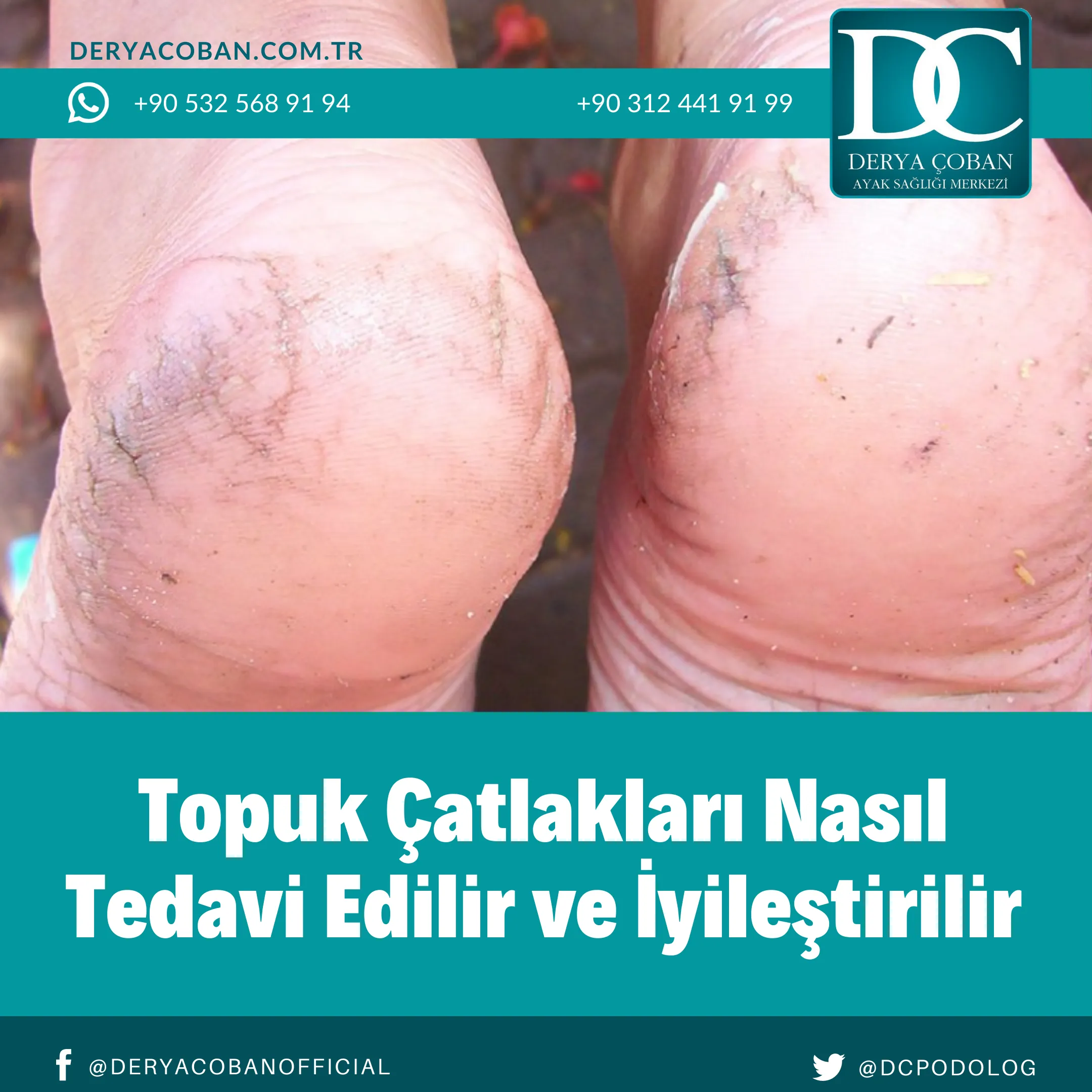 Topuk Çatlakları Nasıl Geçer? Topuk Çatlağına Ne İyi Gelir?