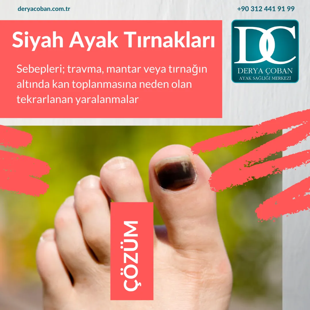 Koyu renk Ayak Tırnakları /Siyahlaşmış Ayak Tırnakları