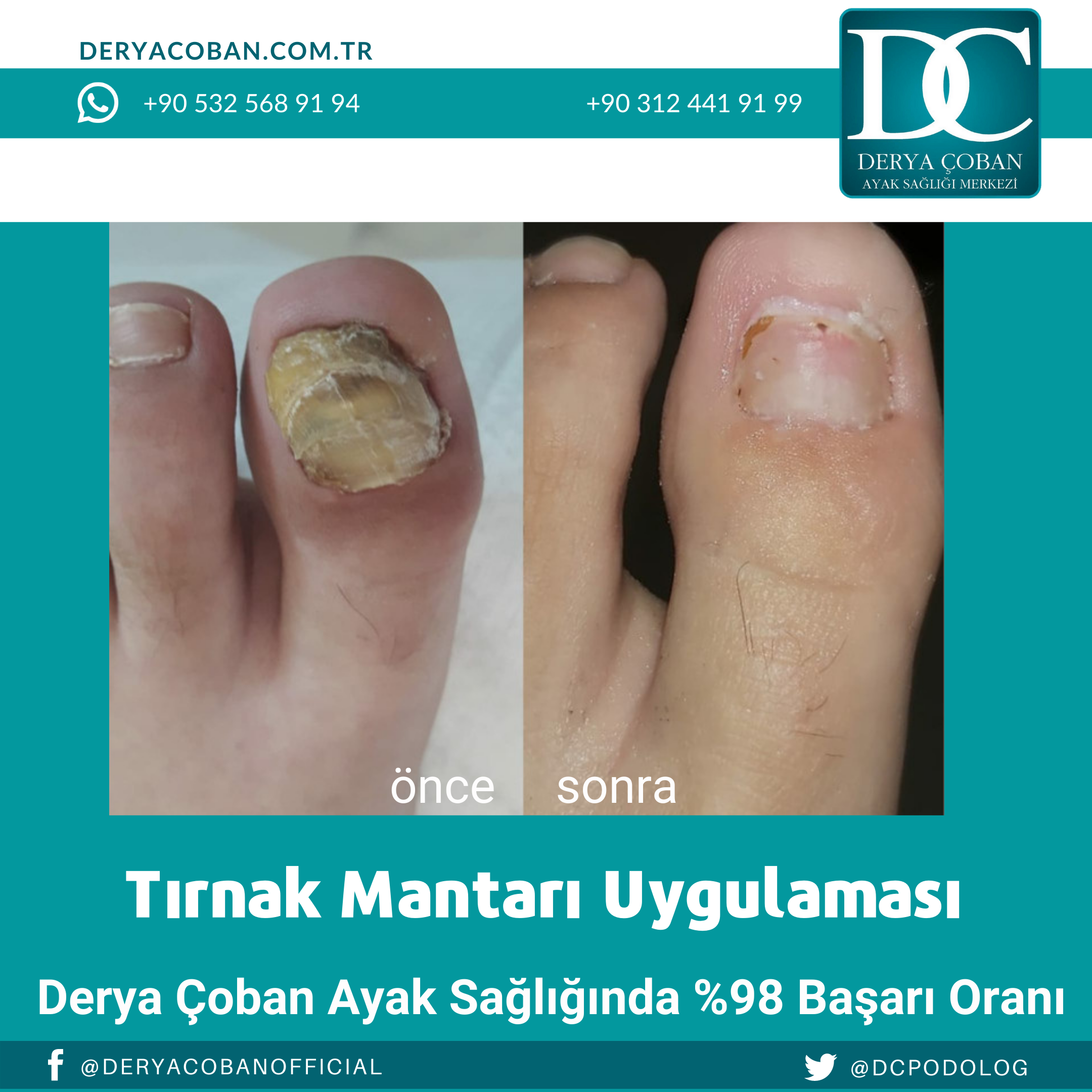 Tırnak mantarı tedavisi