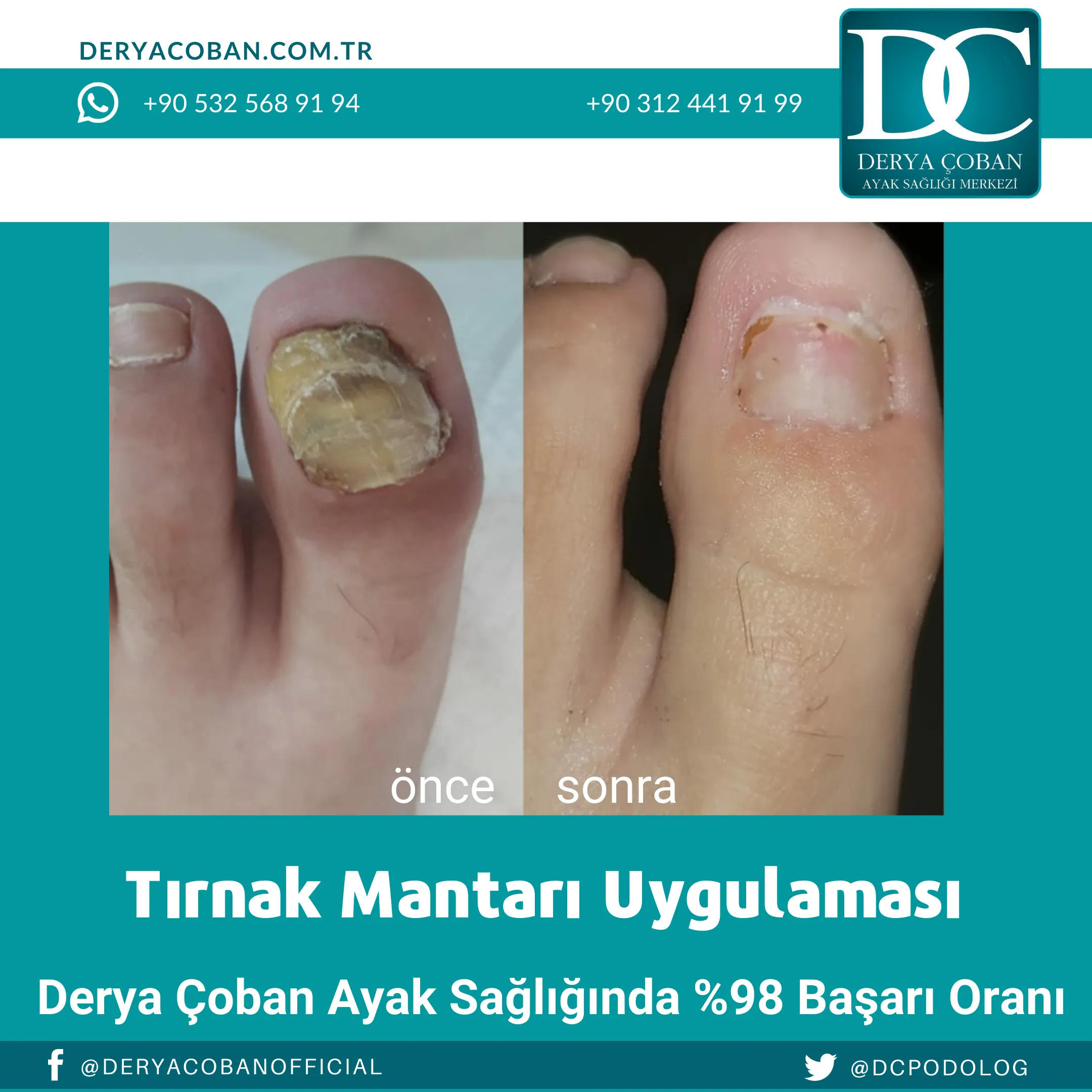 Tırnak mantarı tedavi önce sonrası