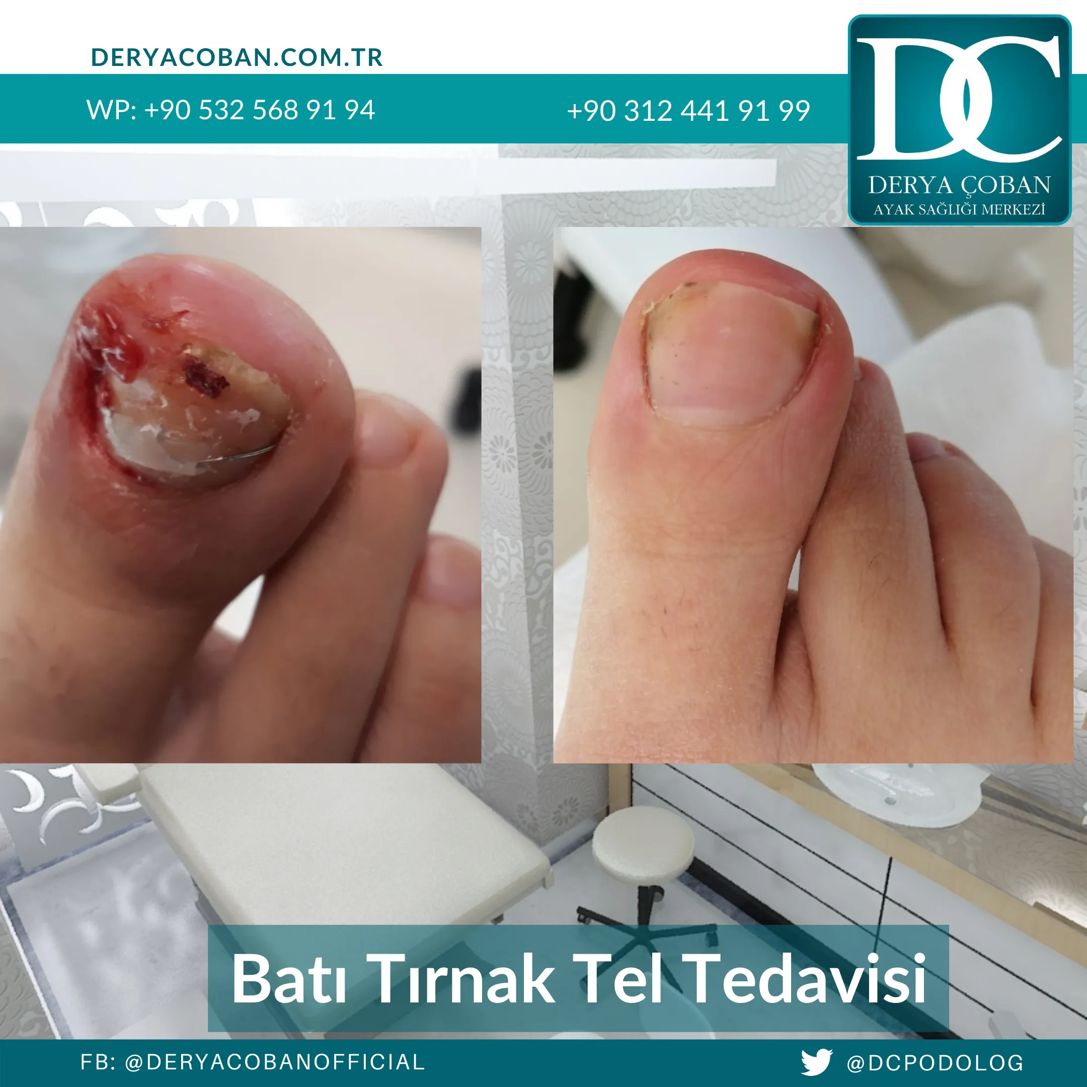 Batık tırnak Tedavi önce ve sonrası Podolog Derya Çoban uygulaması