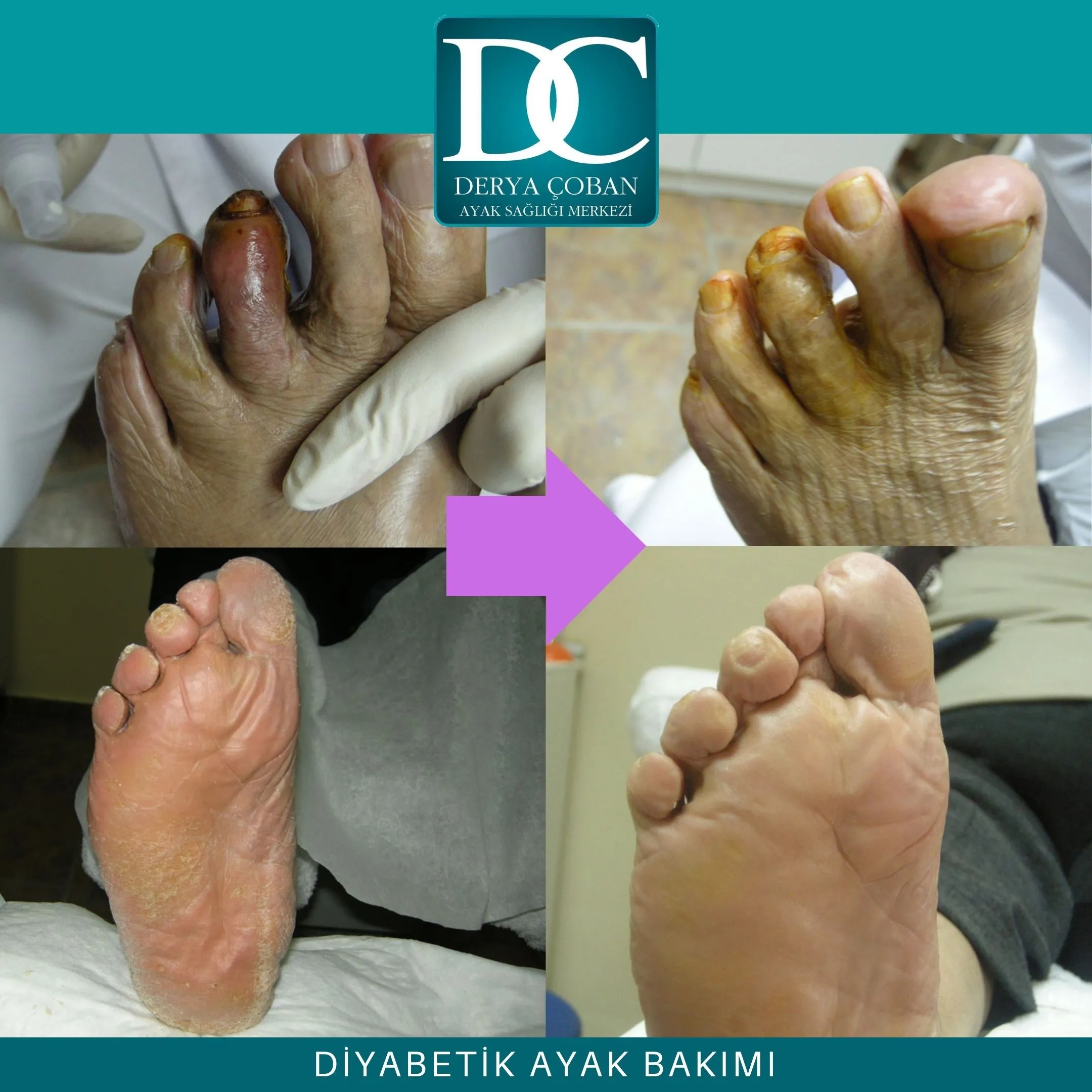 Diyabetik Ayak Bakımı — Ankara Podoloji Kliniği Uygulaması