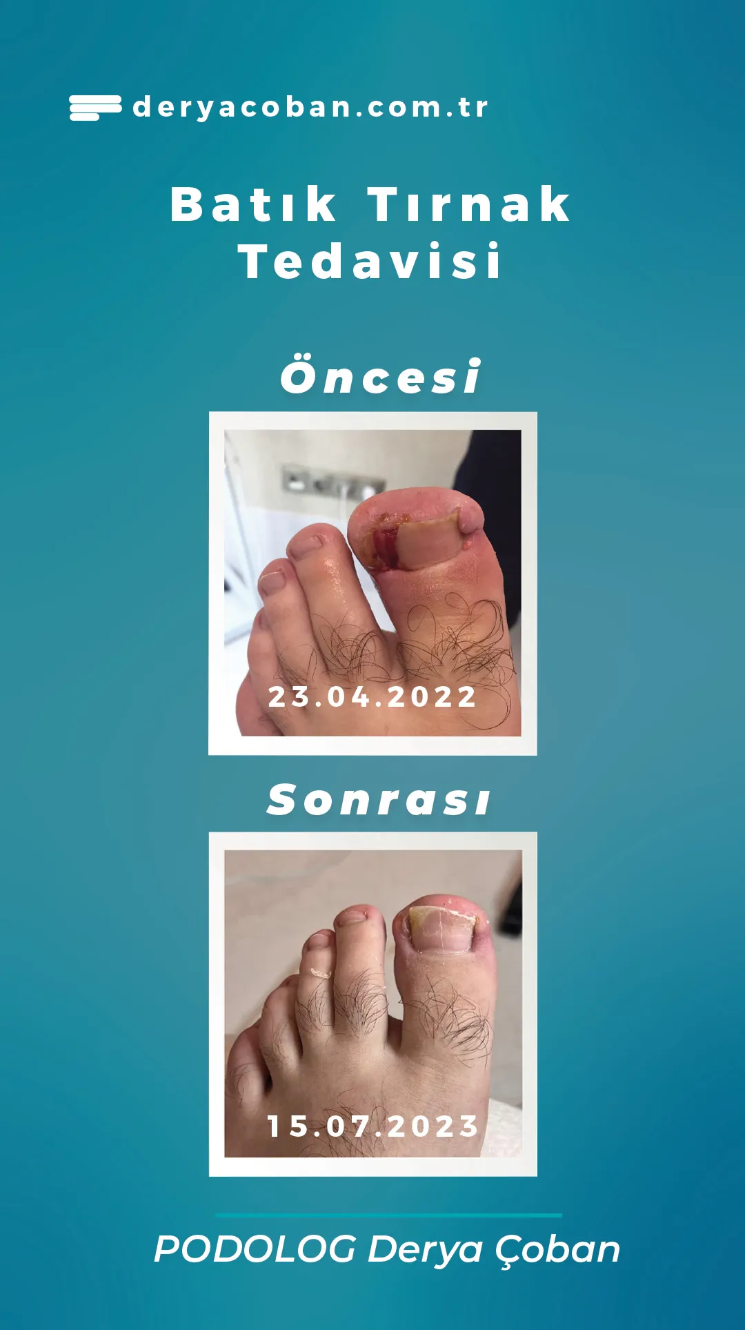 Batık tırnak uygulama öncesi sonrası 