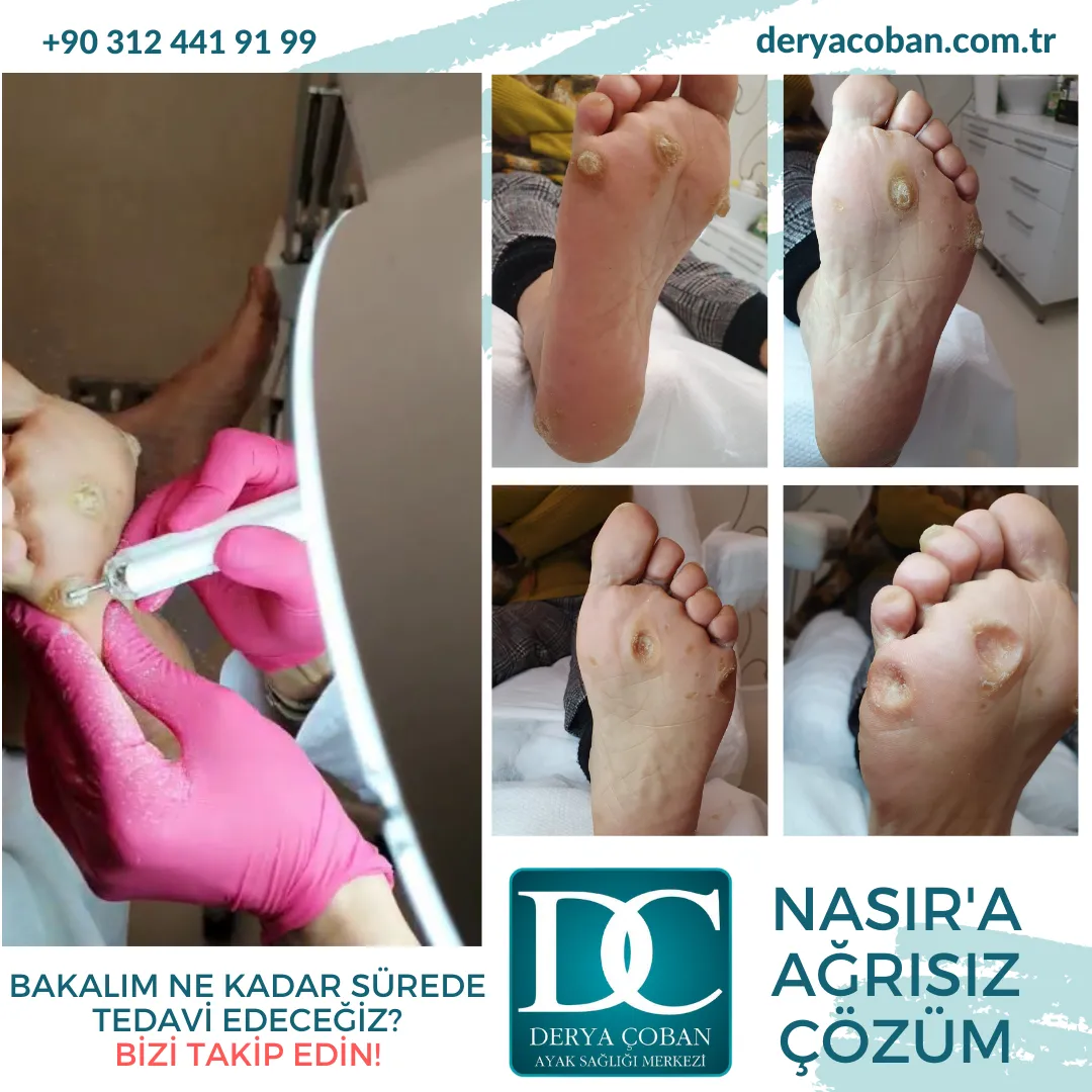 Nasır Problemi Nasıl Çözülür? — Turquoise Brush Strokes Beach Instagram Post Kopyasi Kopyasi